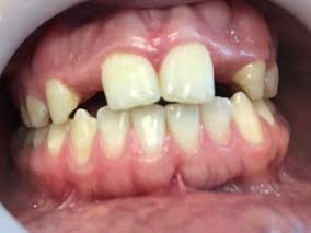 Dentist Near Me - Immediate Implant Before